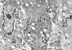 M,35y. | duodenum … lipid malabsorption - susp. hypo-beta-lipoproteinemia